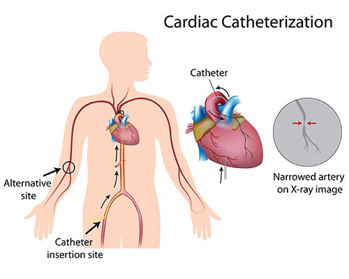 cardiaccatheterization pre and post operation care patient