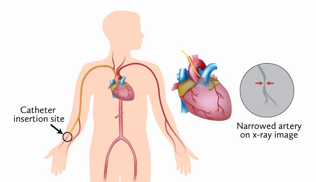 coronary angiogram